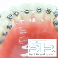 lingual braces