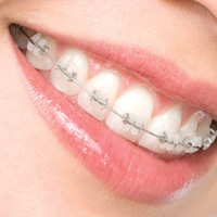 Clear or ceramic braces