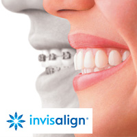 Invisalign