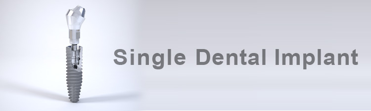 Single Dental Implant