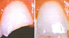 Bangkok Indirect Veneers, Thailand Dental Bonding