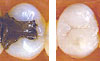 Bangkok Composite Fillings, Thailand Resin Fillings