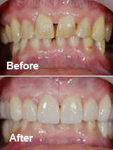 All-on-5 Implants with Overdentures