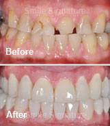 All-on-5 Implants with Overdentures