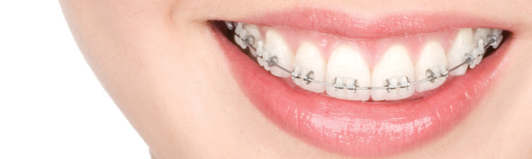 Clear braces and ceramic braces