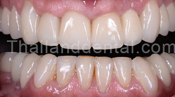 Dental Crown Cases