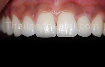 Case Implant All-On-4
