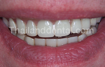 Case Implant All-On-4