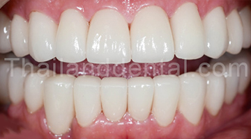 Case Tooth Whitening