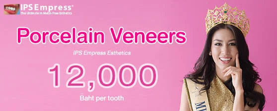 Ceramic IPS Veneers