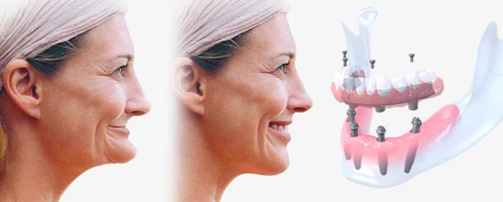 Full Mouth Dental Implants