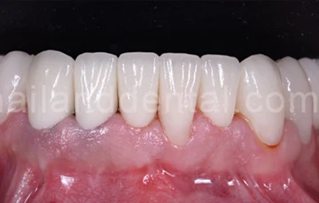 ครอบฟันคืออะไร