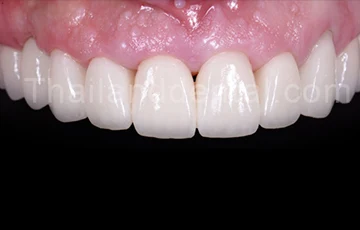 ครอบฟันราคา