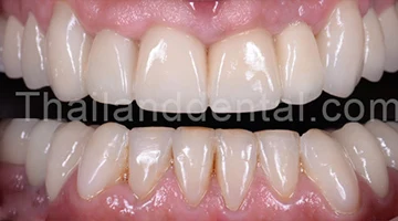 Dental Crowns