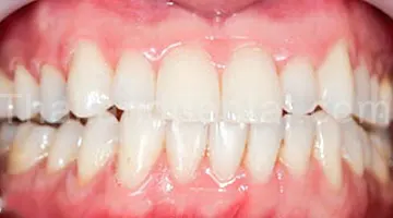 Invisalign