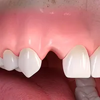 Ceramic implant borne single tooth treatment