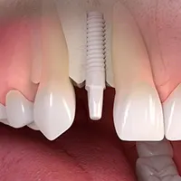 Ceramic implant borne single tooth treatment