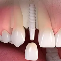 Ceramic implant borne single tooth treatment
