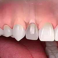 Ceramic implant borne single tooth treatment