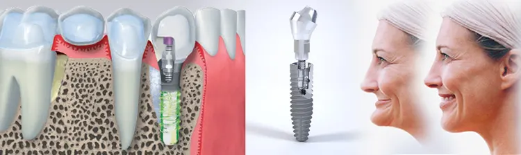 Dental Implants