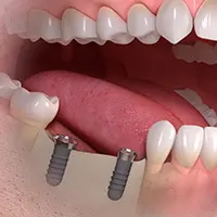 Implant borne multi tooth treatment