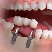 Dental Implants