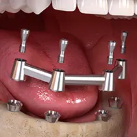 Full Arch Overdentures