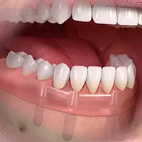 Full Arch Overdentures
