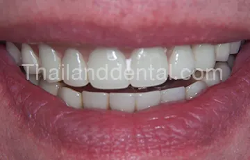 dental implants