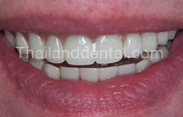 Dental Implants