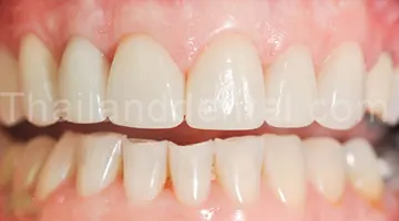 Dental Veneers