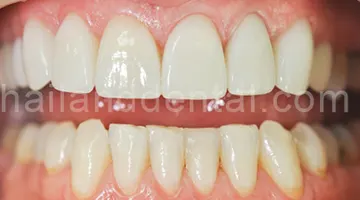 Dental Veneers
