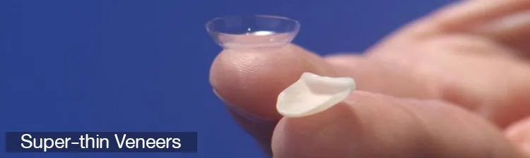 Super thin Veneers