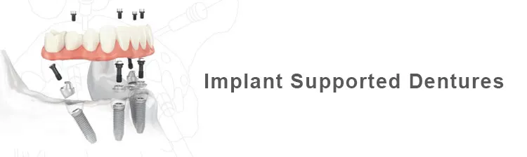 Dental Implant