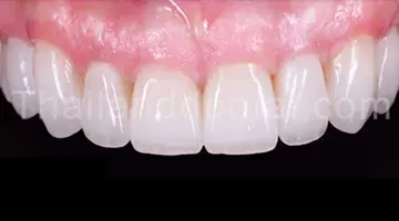 veneers